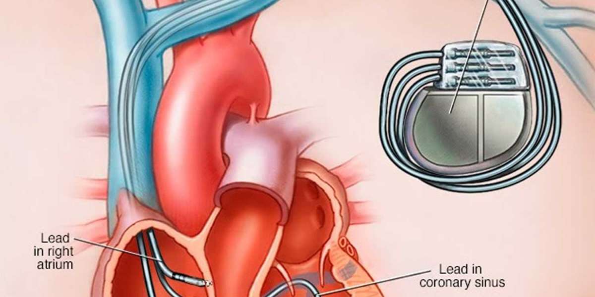 Expérience du Sénégal sur les pacemakers reconditionnés : à propos de 161 patients au CHU HALD Dakar